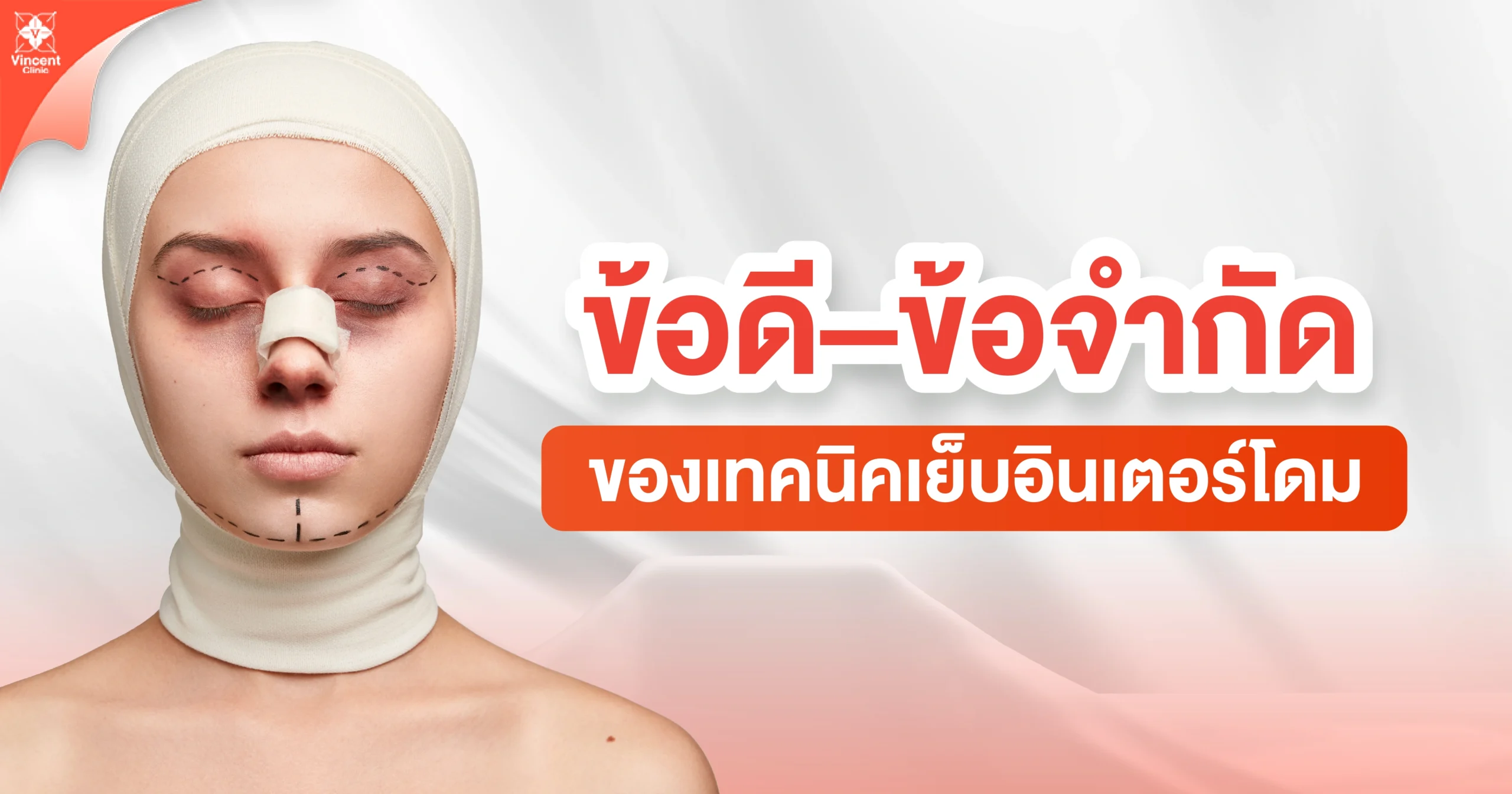 ข้อดี ข้อดีจำกัด ของเทคนิคเย็บอินเตอร์โดม