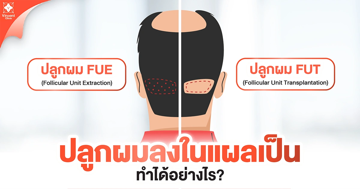 ปลูกผมลงในแผลเป็นทำได้อย่างไร