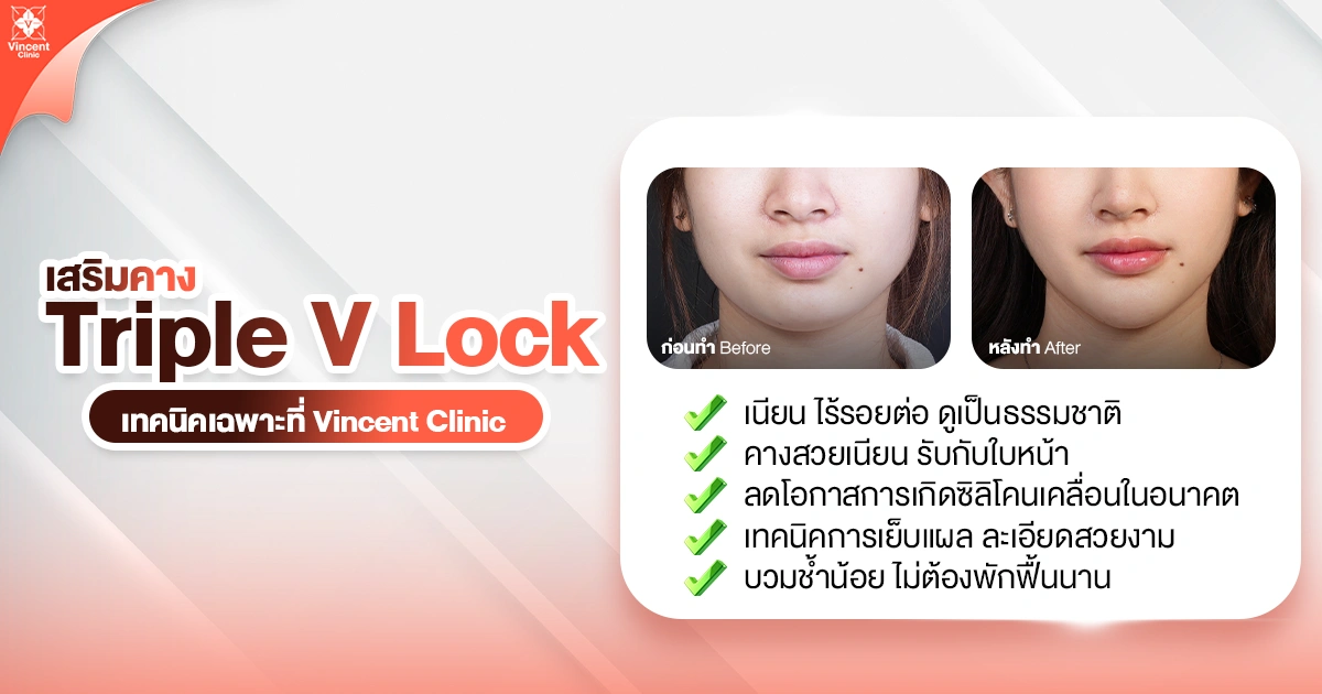 เสริมคาง Triple V Lock