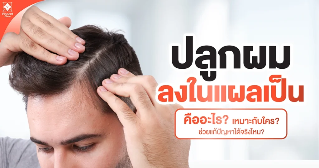 ปลูกผมลงในแผลเป็นคืออะไร