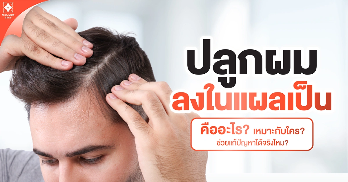 ปลูกผมลงในแผลเป็นคืออะไร
