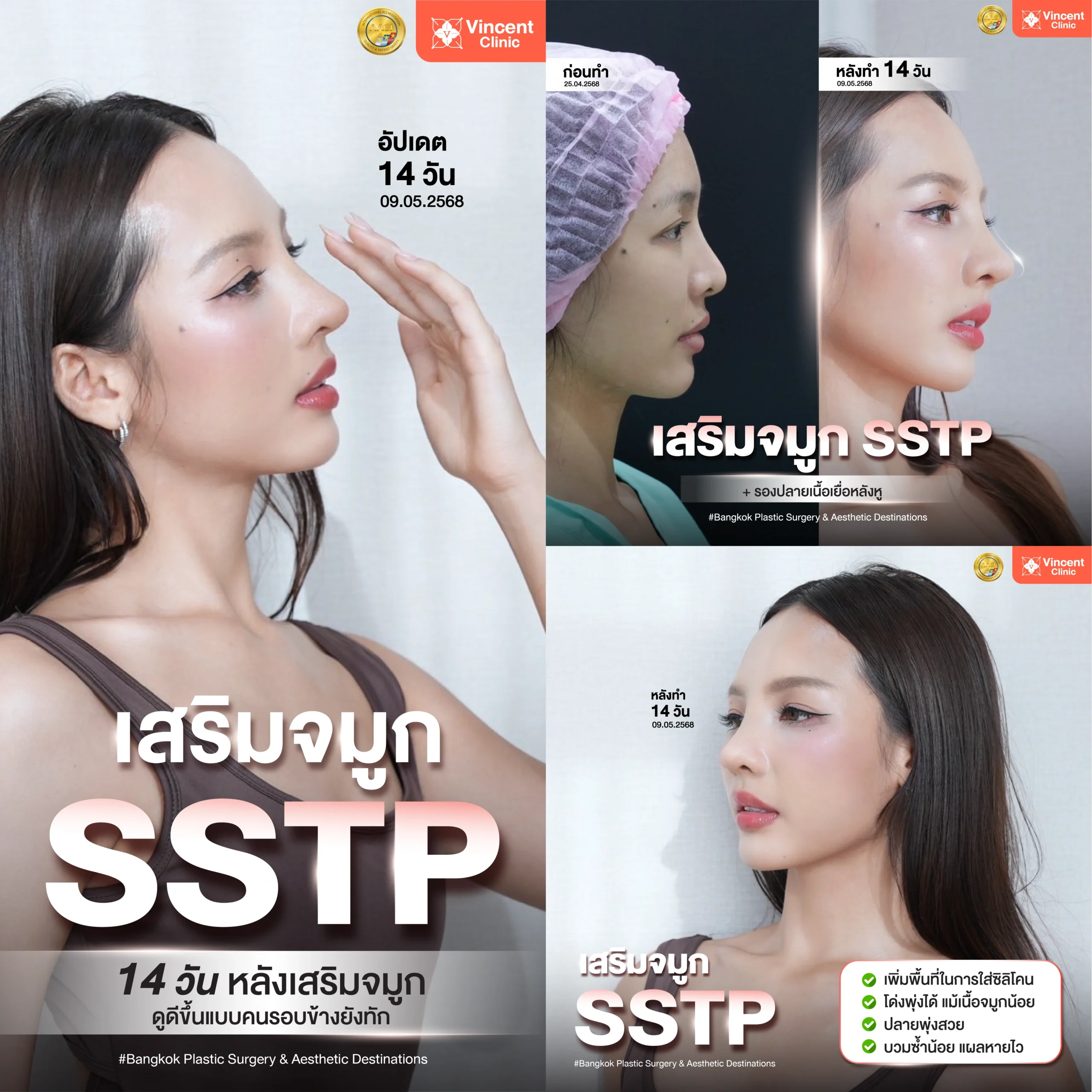 ทำจมูกที่ Vincent Clinic