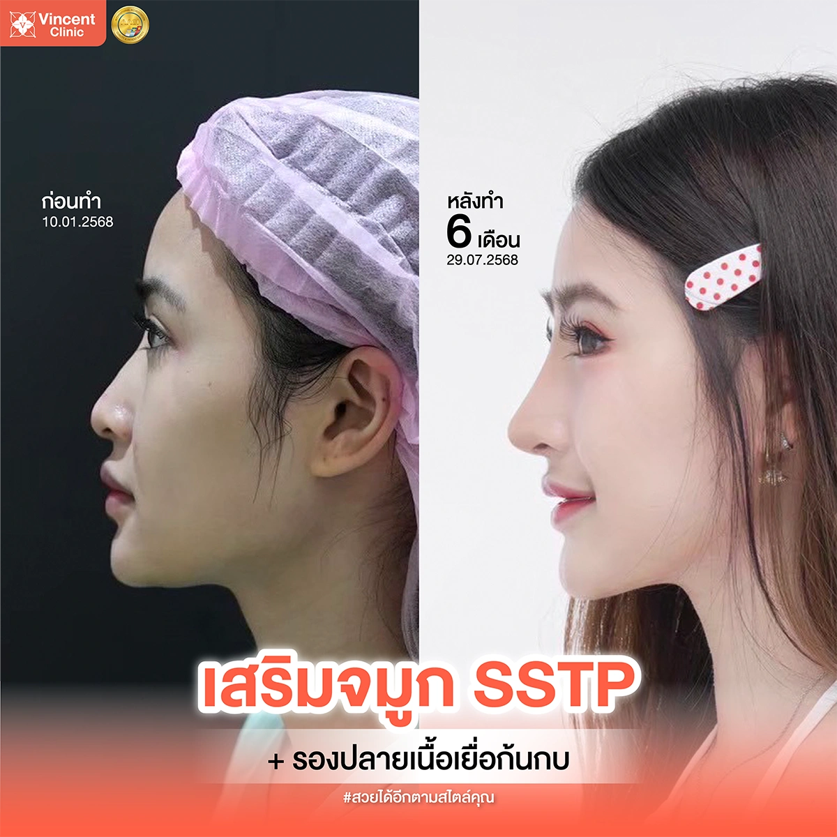 รีวิวเสริมจมูก