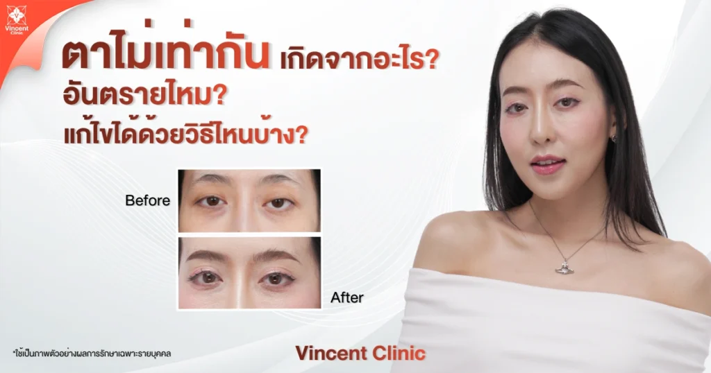 ตาไม่เท่ากันเกิดจากอะไร