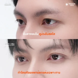 review_eye2