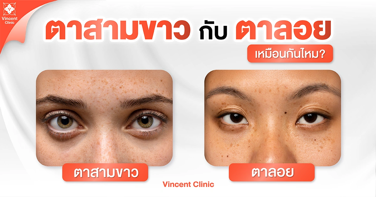 ตาสามขาวกับตาลอยเหมือนกันไหม