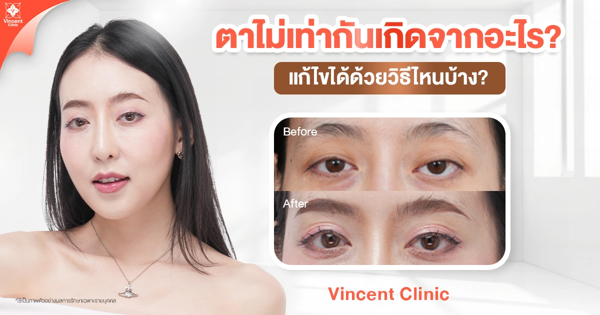 ตาไม่เท่ากันเกิดจากอะไร