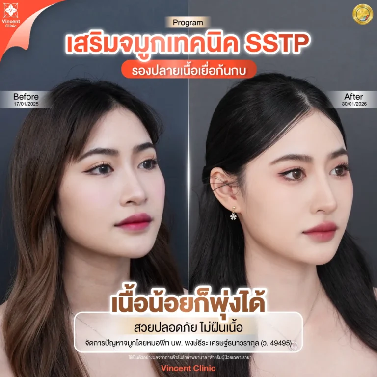 รีวิว เสริมจมูก SSTP เนื้อเยื่อก้นกบ Before After โดย หมอพีท