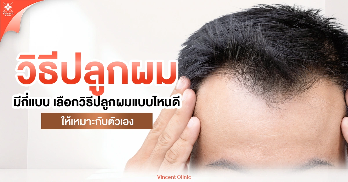 เลือกวิธีปลูกผมแบบไหนให้เหมาะกับตัวเอง