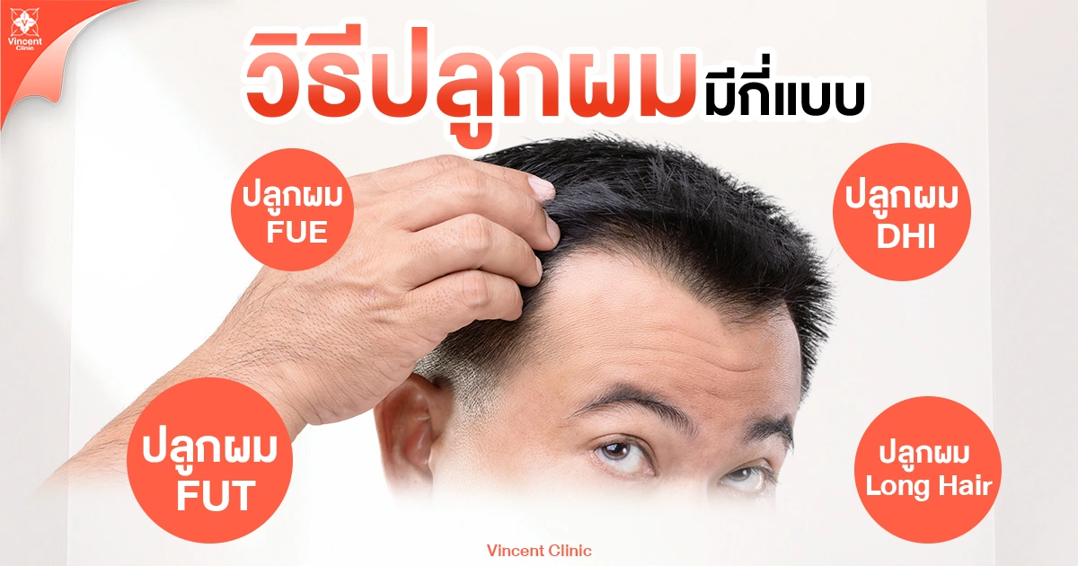 วิธีปลูกผมมีกี่แบบ