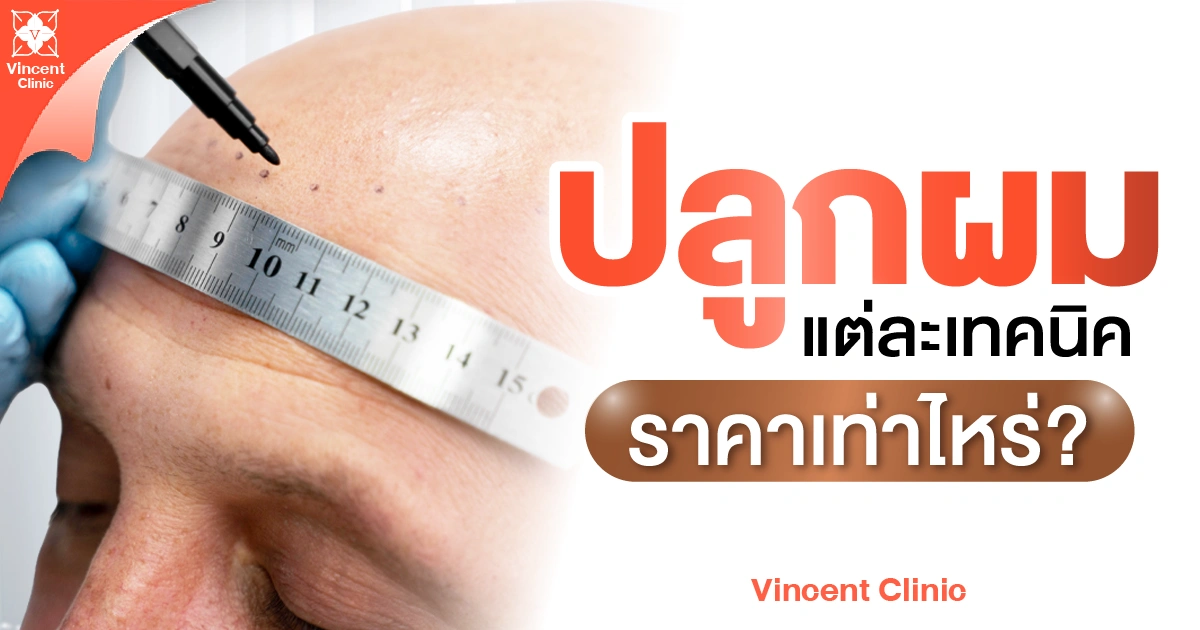 How much does each hair transplant technique cost? ปลูกผมราคา แต่ละเทคนิคอยู่ที่เท่าไหร่