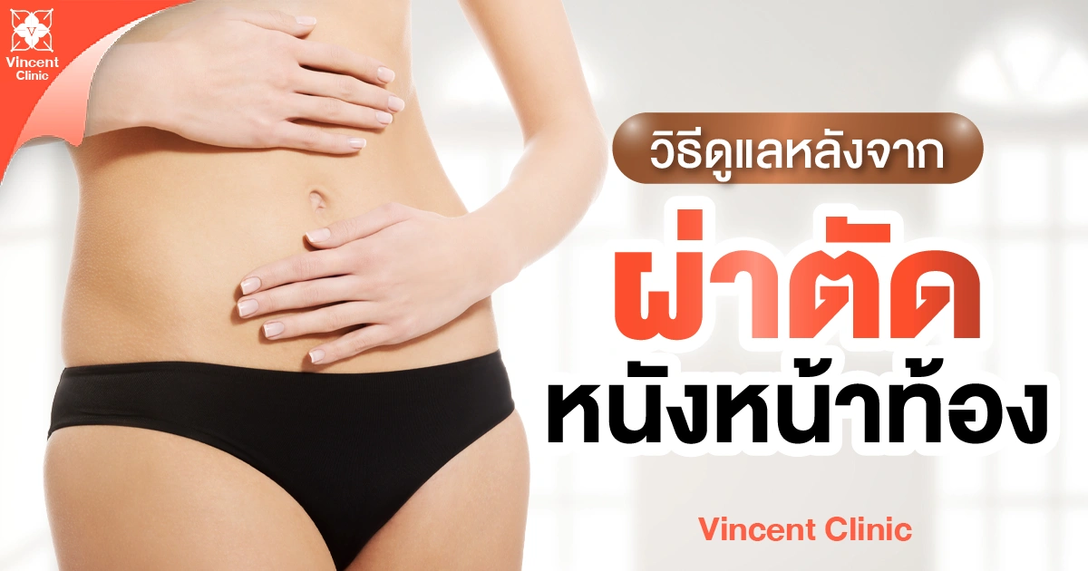 วิธีดูแลหลังจากผ่าตัดหนังหน้าท้อง