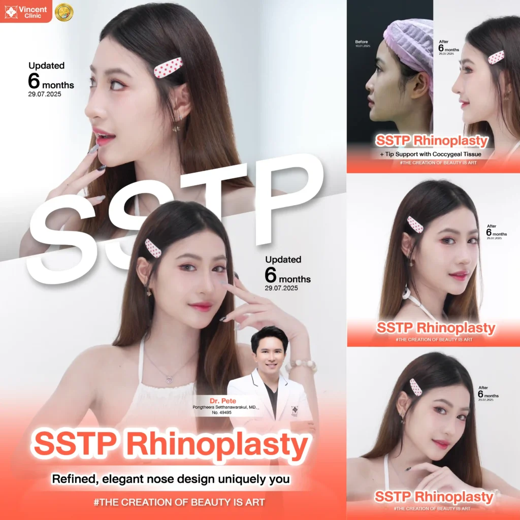 รีวิว เสริมจมูก คุณใบเตย โดยหมอพีท วินเซนต์คลินิก