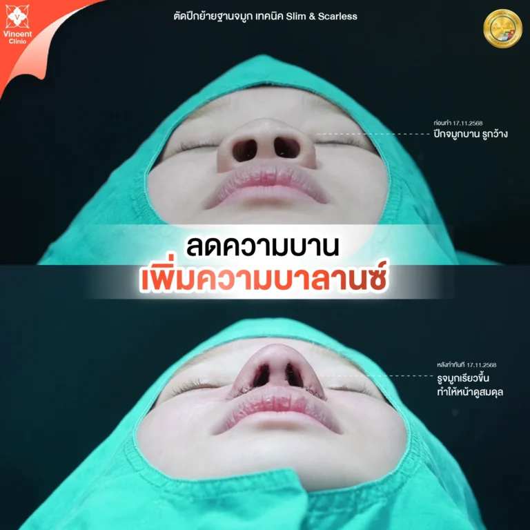 รีวิวศัลยกรรมตัดปีกจมูก Vincent Clinic