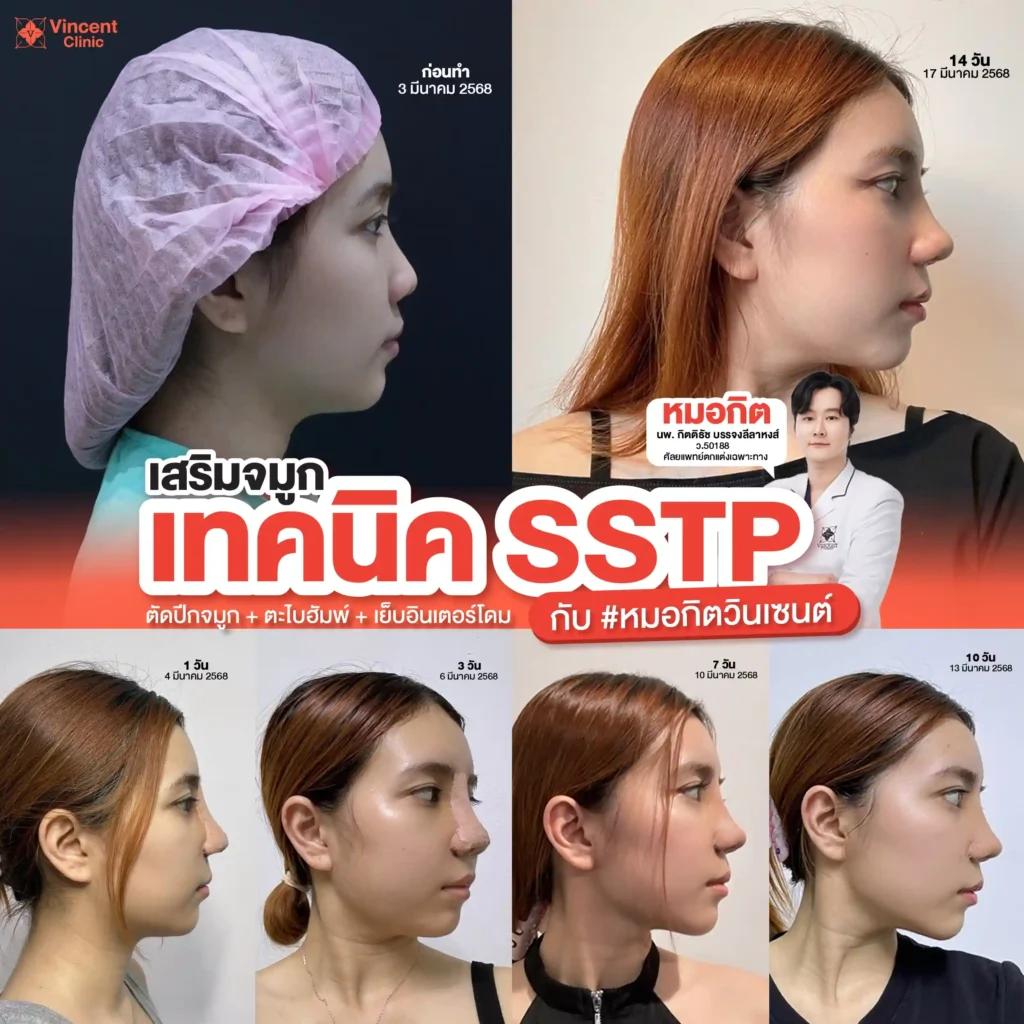 รีวิว เสริมจมูก เทคนิค SSTP หมอกิตวินเซนต์คลินิก