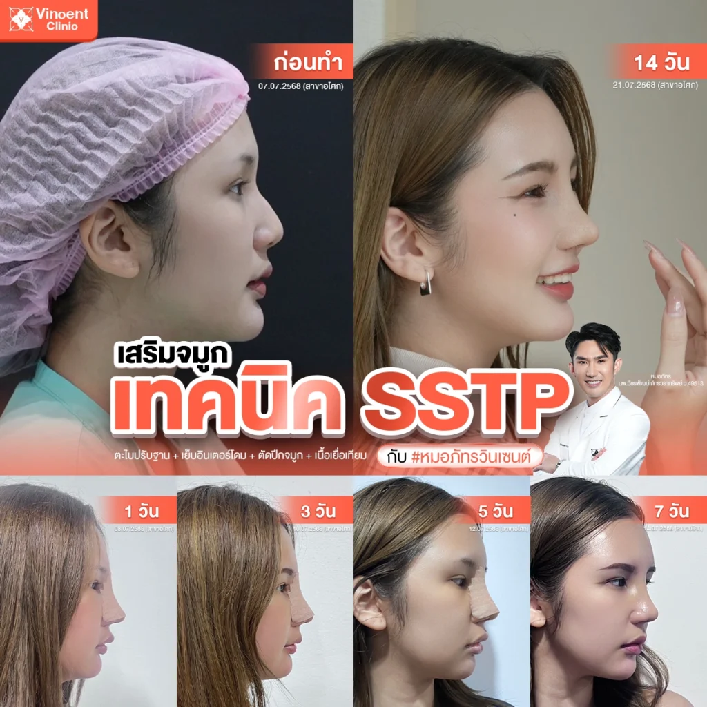 REVIEW เสริมจมูก คุณเอญ่า โดยหมอภัทร วินเซนต์คลินิก