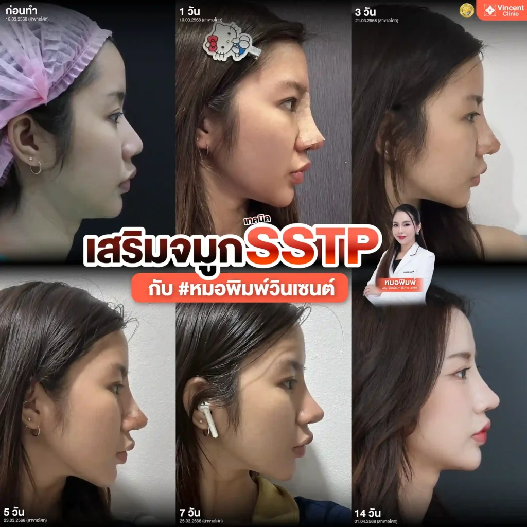 รีวิว เสริมจมูก คุณเอิร์น โดยหมอพิมพ์ วินเซนต์คลินิก