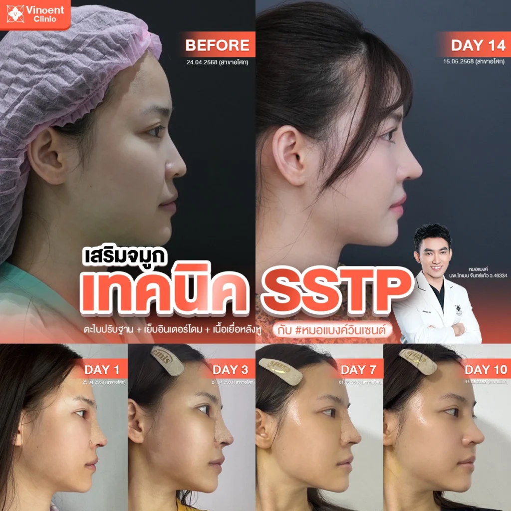 รีวิว เสริมจมูก คุณตุ๊กตา โดยหมอแบงค์ วินเซนต์คลินิก