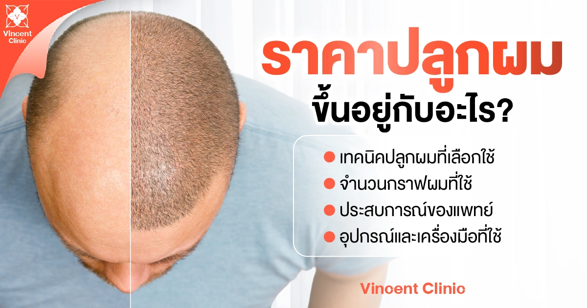What factors does the cost of a hair transplant depend on? ราคาปลูกผม ขึ้นอยู่กับอะไร?