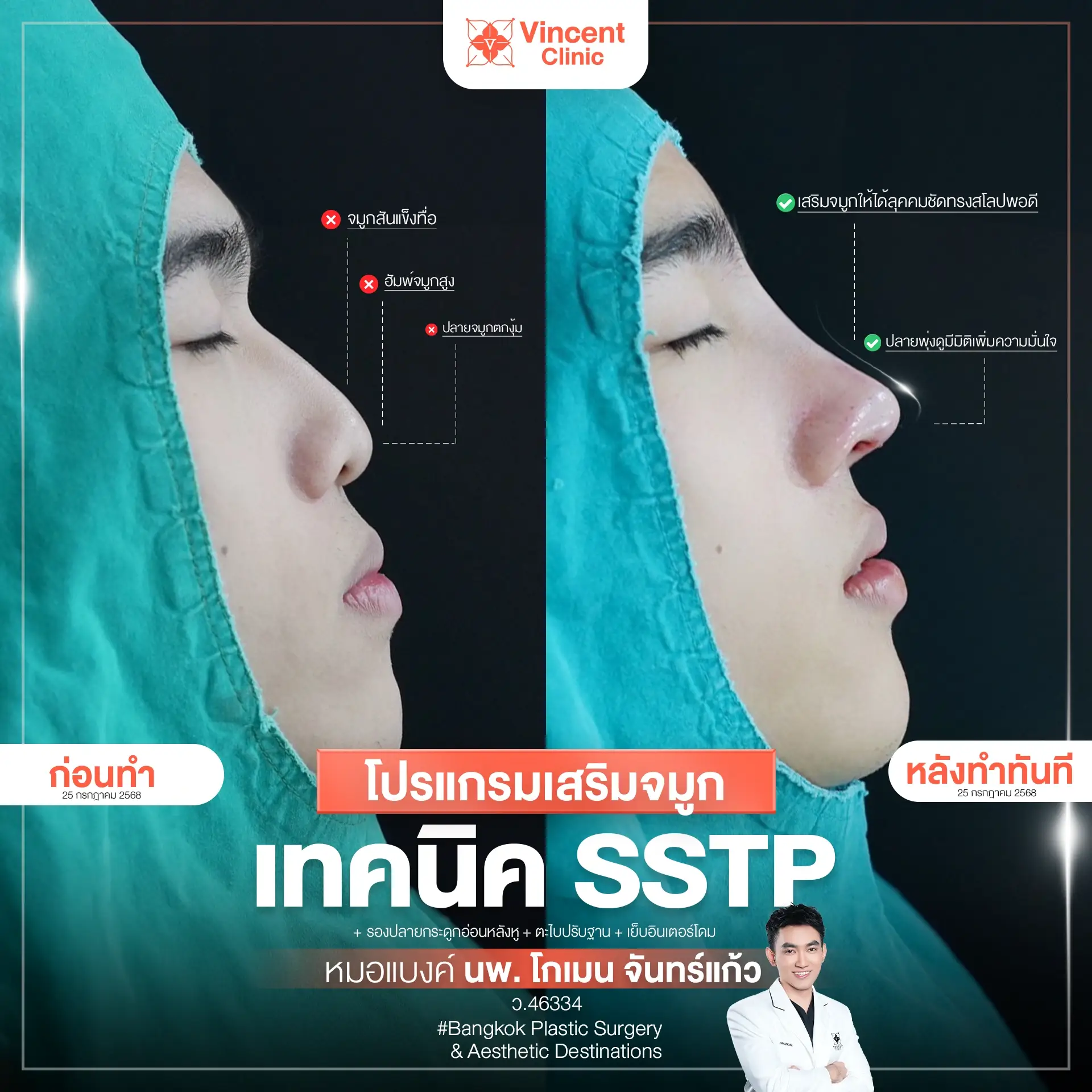 B&A OR เสริมจมูกผู้ชาย คุณต้นกล้า แก้จมูกงุ้ม โดยหมอแบงค์