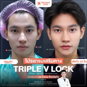 รีวิวเสริมคาง คุณฮุย ศัลยกรรมโดยหมอแบงค์