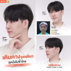 คุณโน๊ต REVIEW เสริมคาง กับหมอภัทร