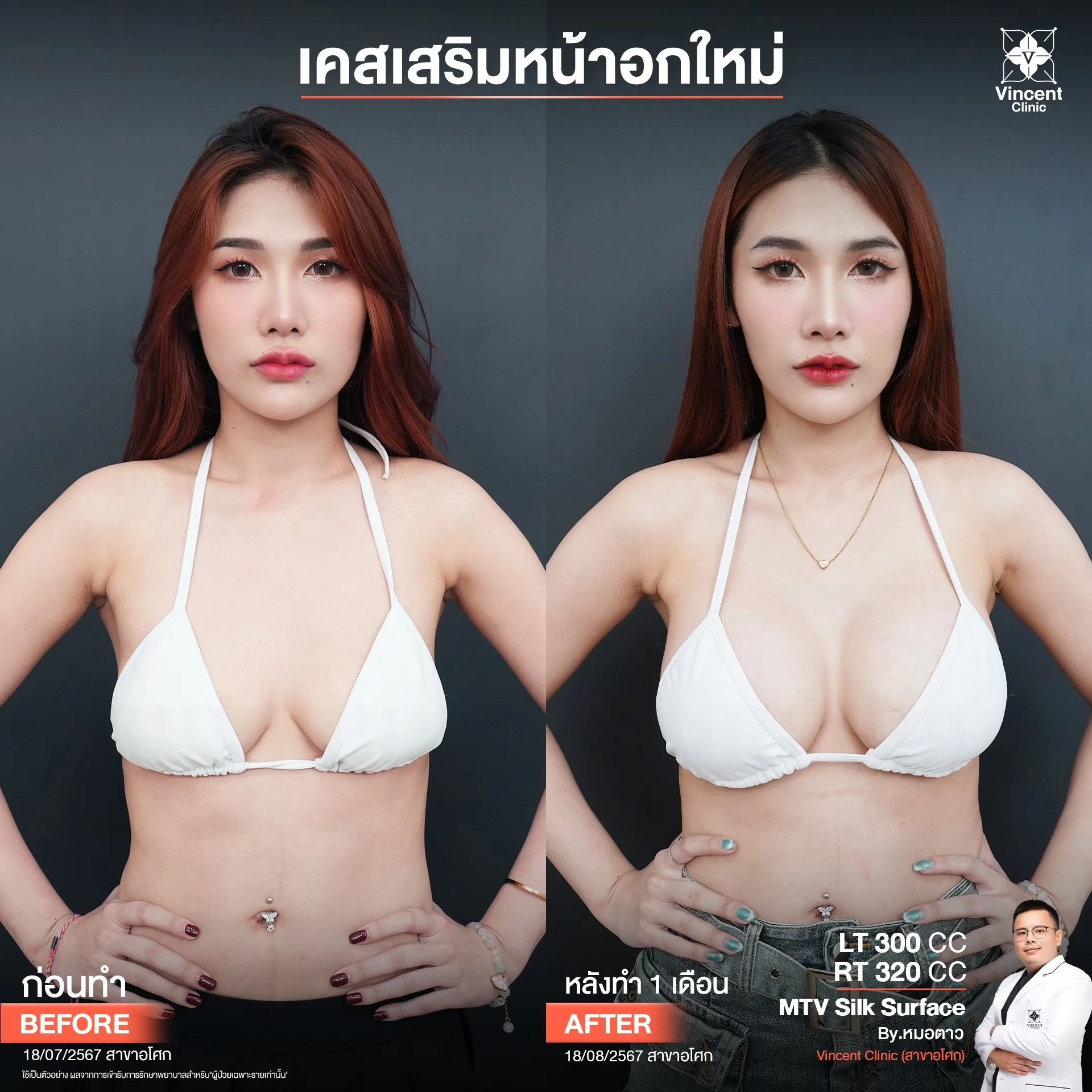รีวิวเสริมหน้าอก 300 cc