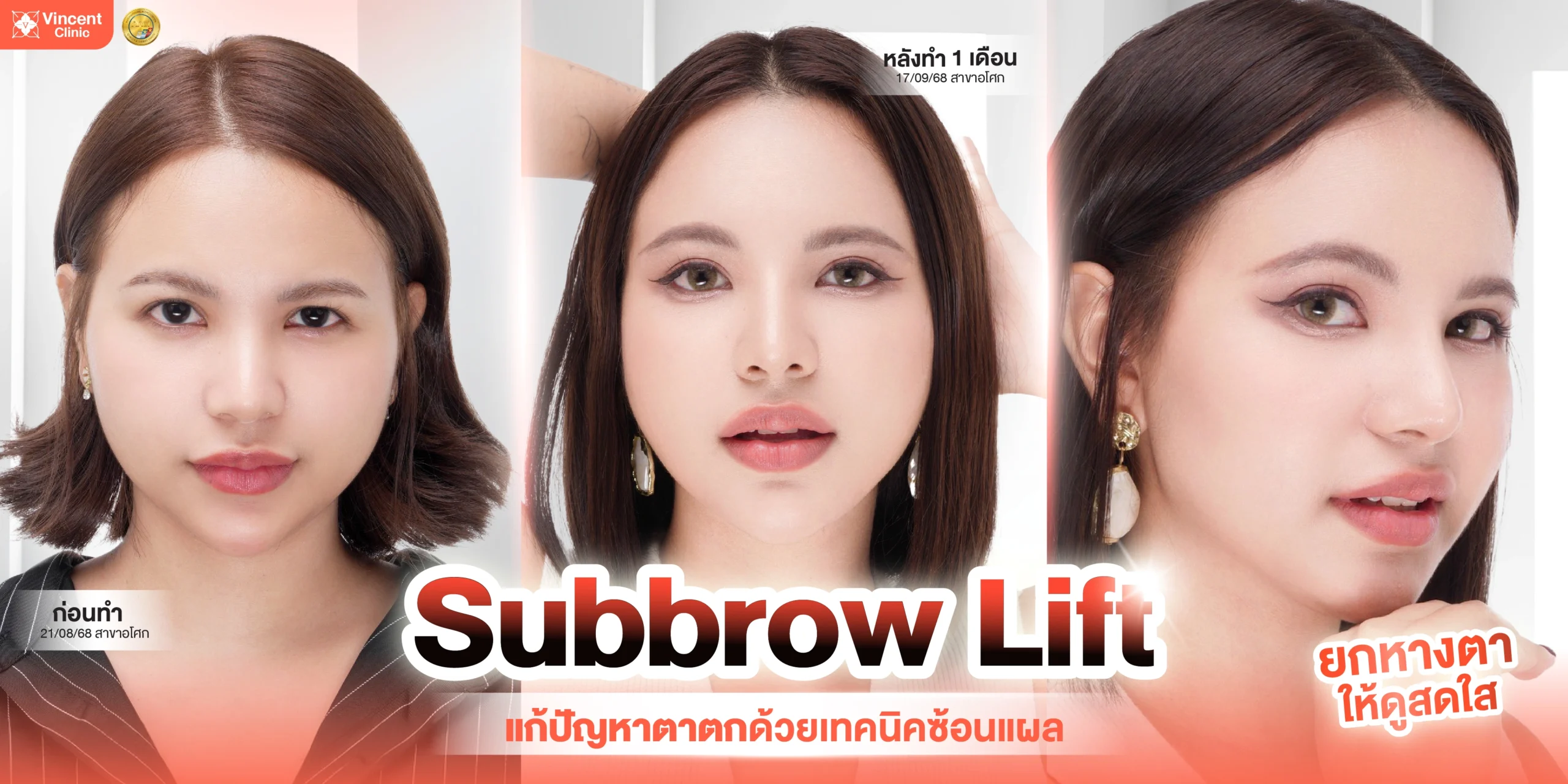 โปรแกรม Subbrow Lift ที่ Vincent Clinic