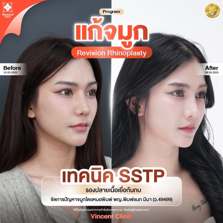 รีวิว แก้จมูก กับหมอพิมพ์ Vincent Clinic