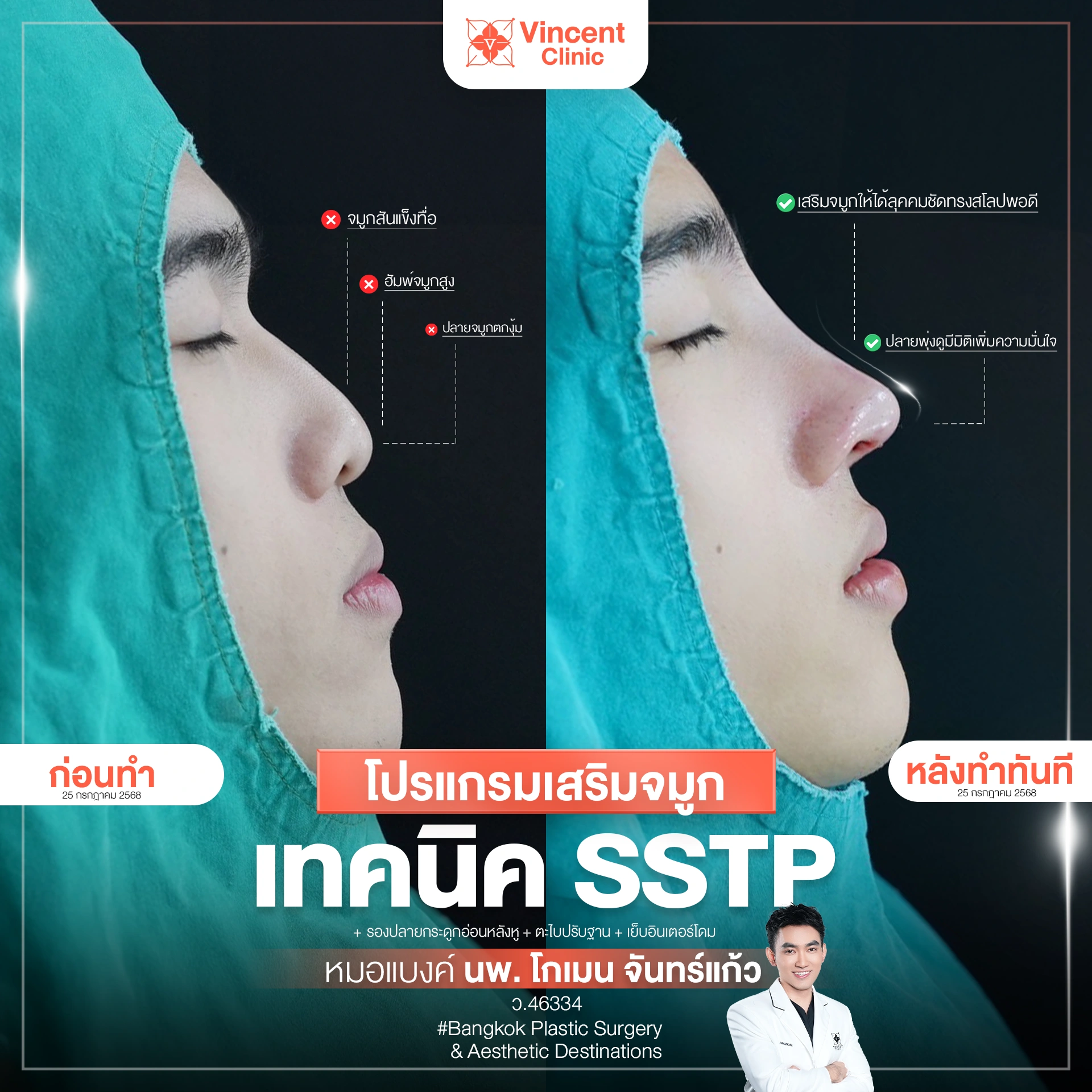 รีวิว เสริมจมูกผู้ชาย ทรงสโลปปลายพุ่ง Before After