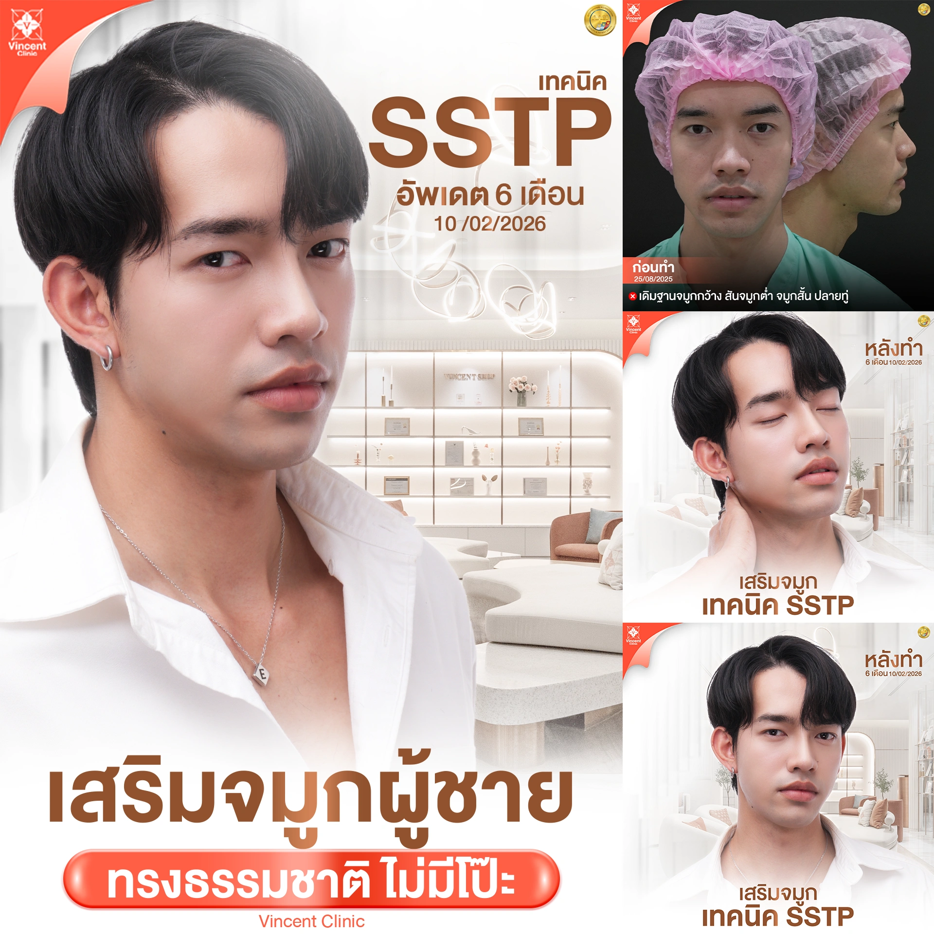 รีวิว เสริมจมูกผู้ชาย SSTP Vincent Clinic