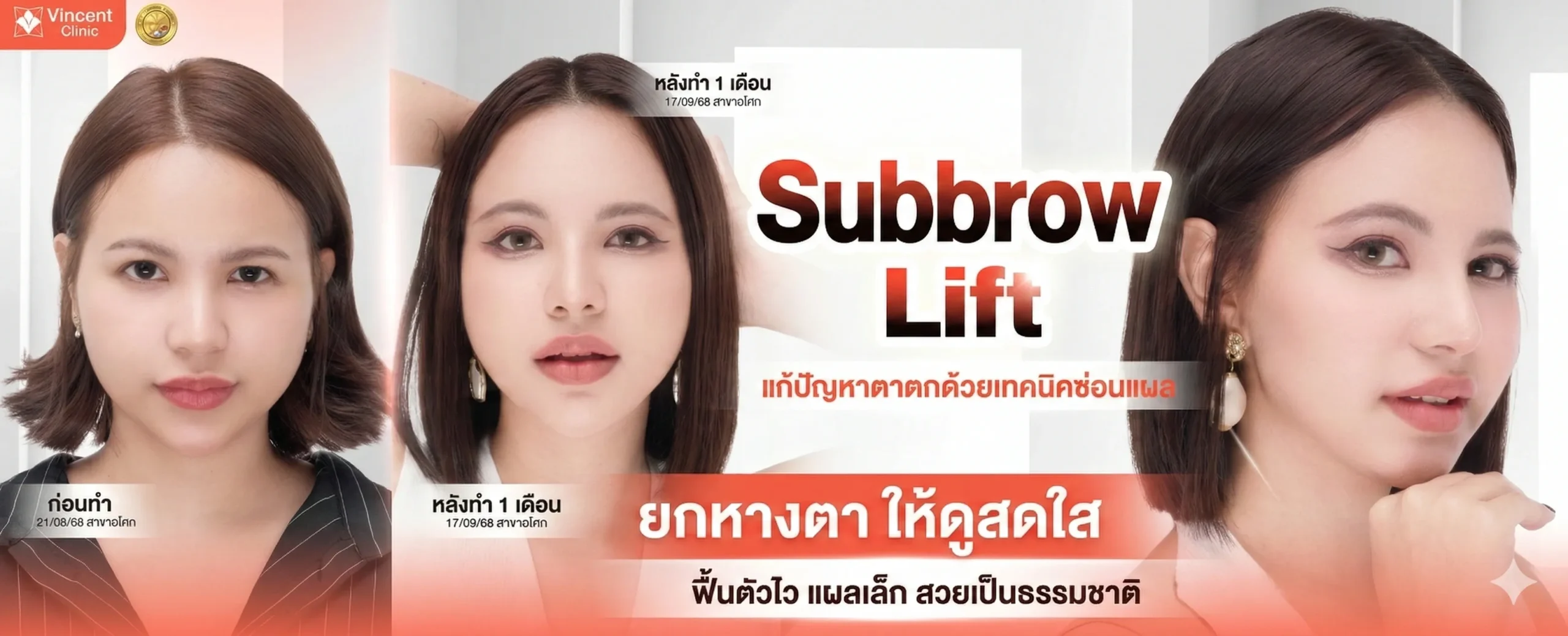โปรแกรม subbrow lift ยกหางตา ยกคิ้วแบบซ่อนแผล