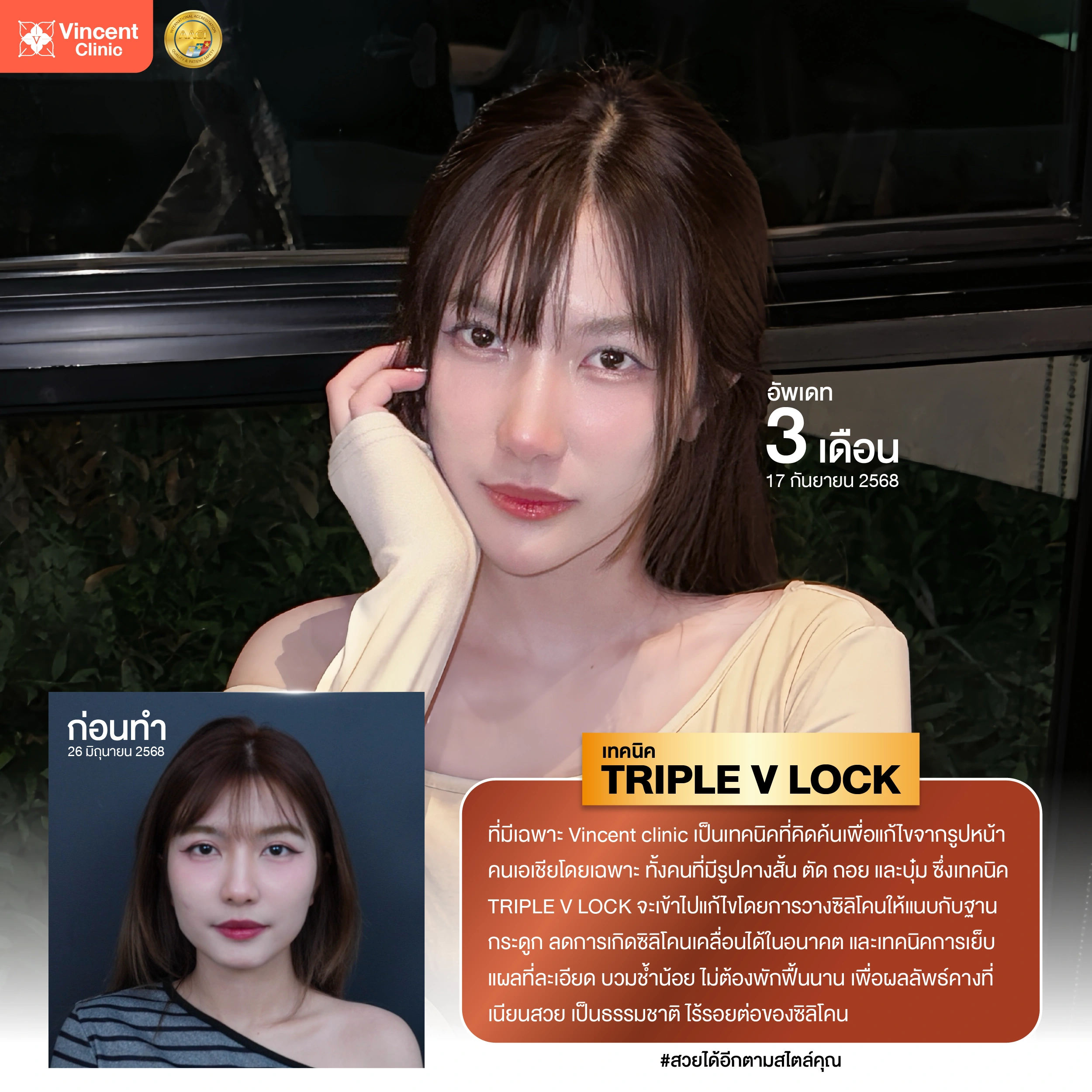 review chin surgery 1