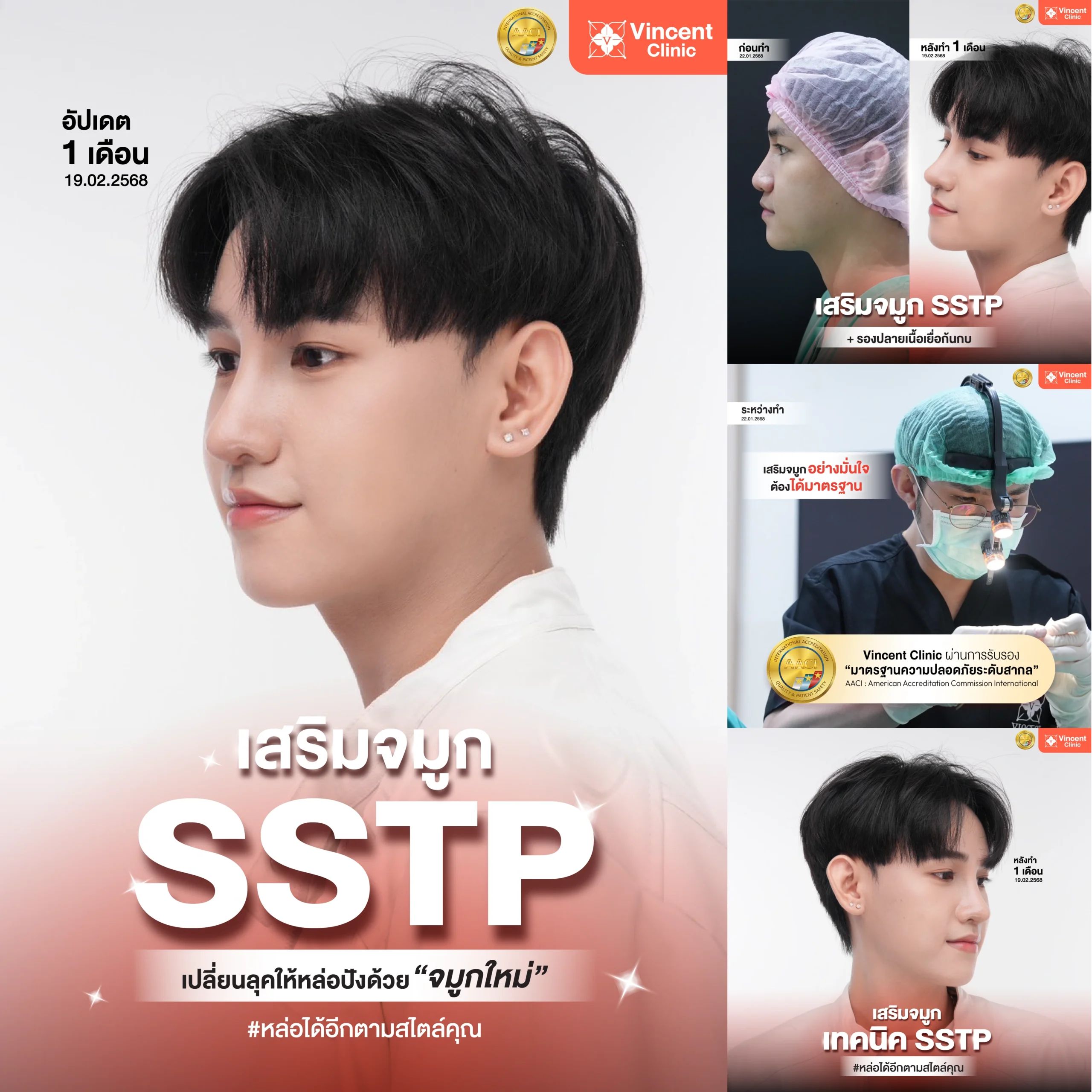 soft-men-rhinoplasty-sstp-vincent-clinic-review