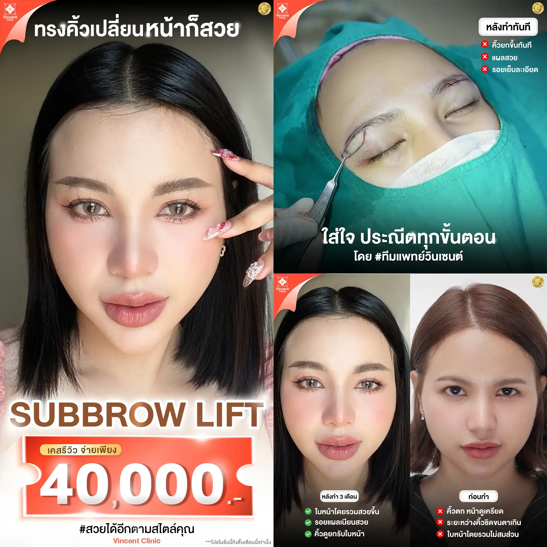 Subbrow Lift ราคาโปรโมชั่น วินเซนต์คลินิก