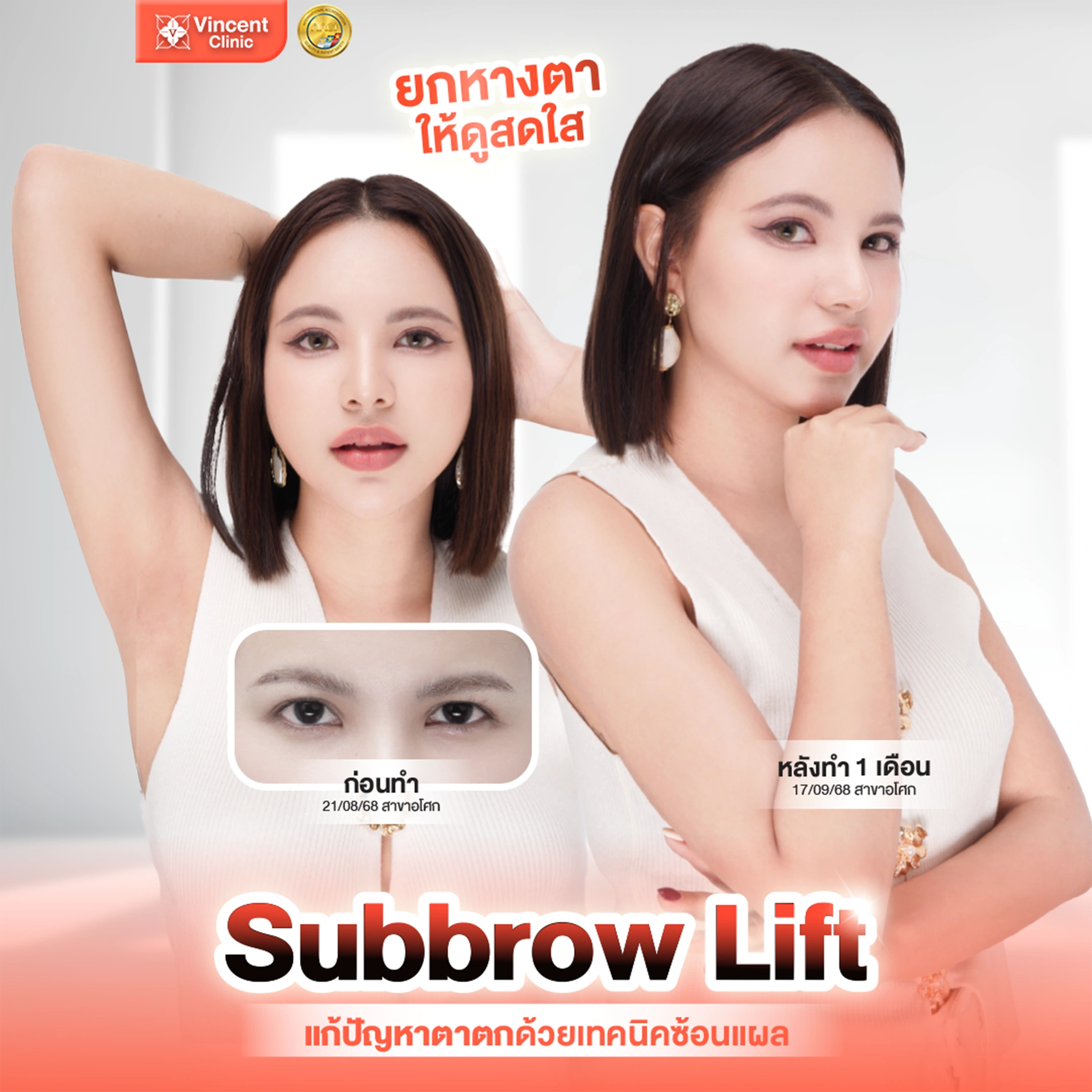 subbrow lift รีวิว