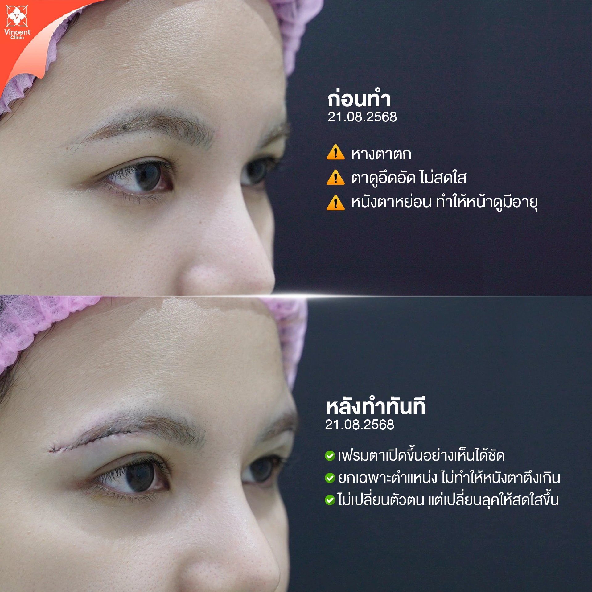subbrow lift รีวิว หลังทำทันที