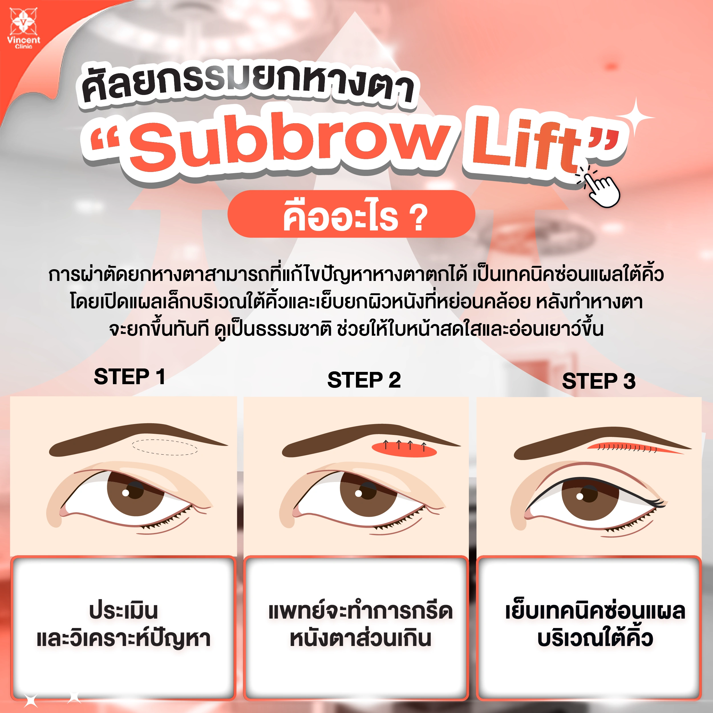 ศัลยกรรมยกหางตา Subbrow lift