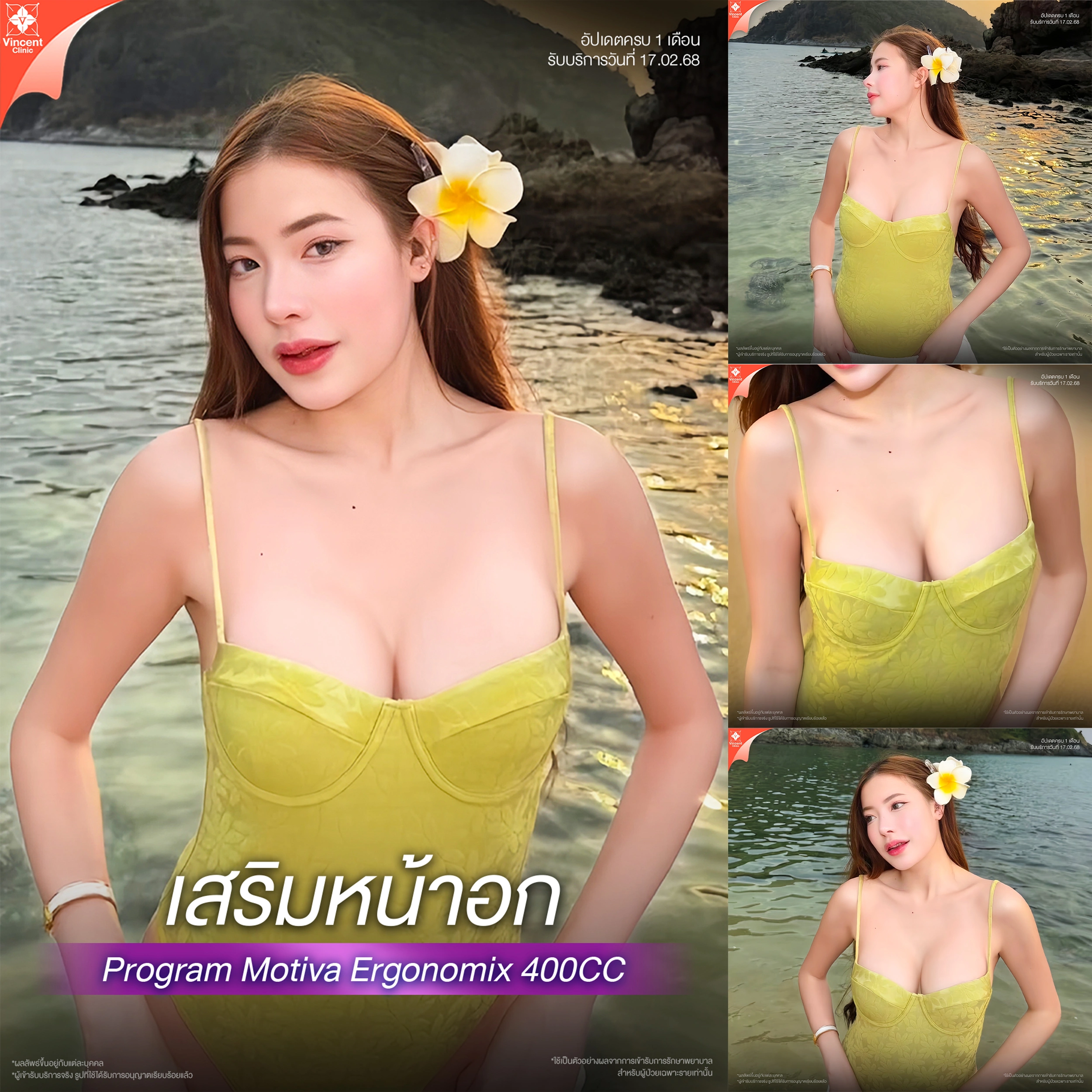 เสริมหน้าอก Motiva Ergonomix รีวิว 400 cc