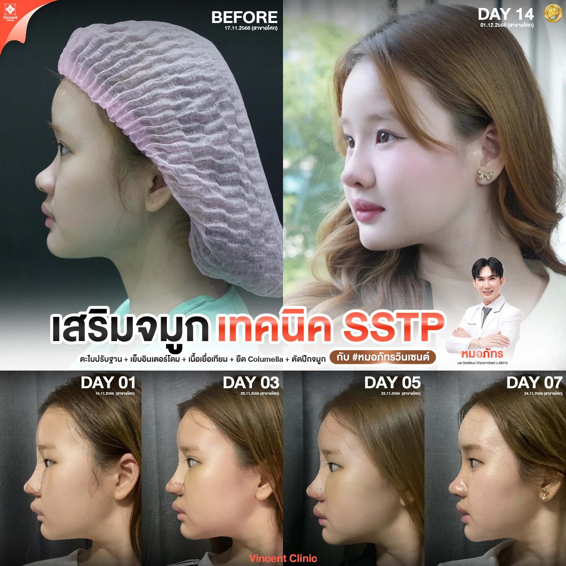 หน้ากลมเสริมจมูกทรงไหนดี