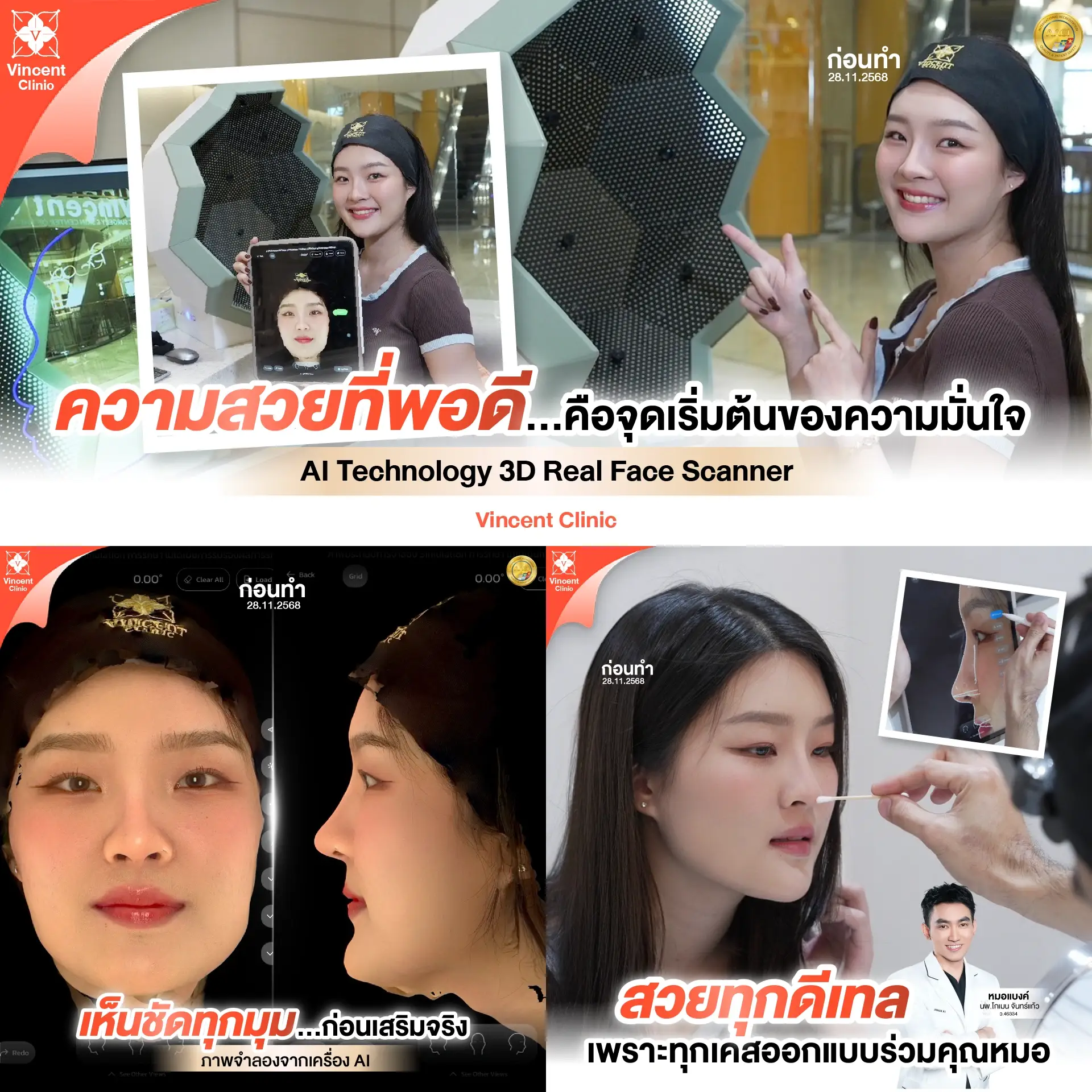 รีวิวเสริมจมูก เทคโนโลยี 3D คุณน้ำฝน หมอแบงค์