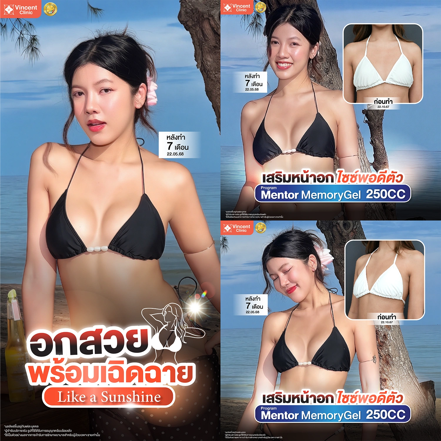 รีวิวเสริมหน้าอก Mentor Memory Gel 250 cc