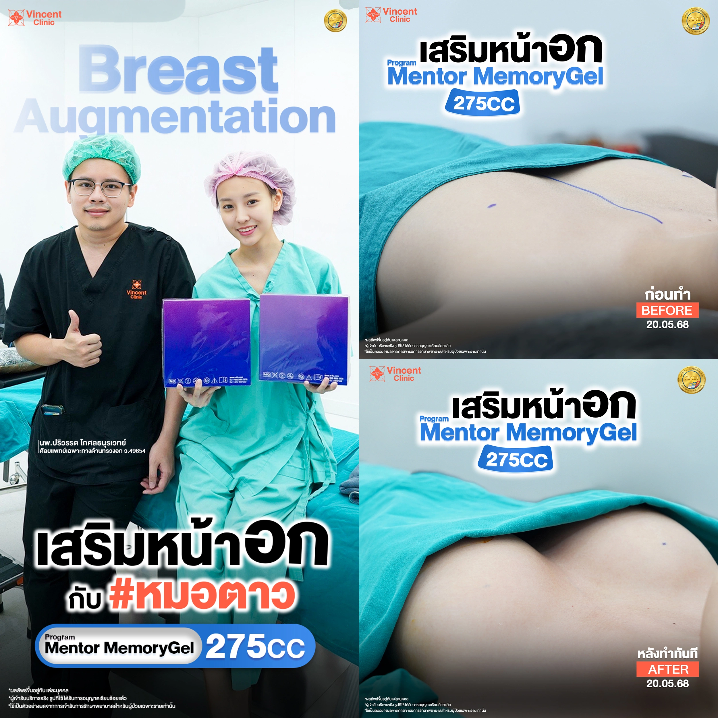 รีวิวเสริมหน้าอก Mentor Memory Gel 275 cc