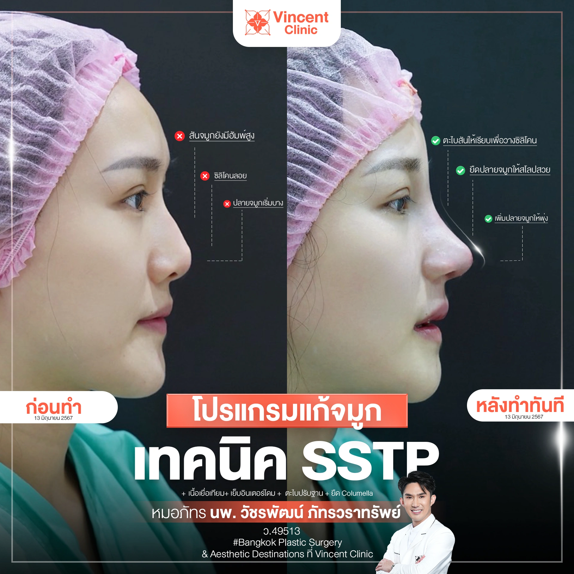 รีวิวแก้จมูก ซิลิโคนลอย ตะไบฮัมพ์ โดยหมอภัทร