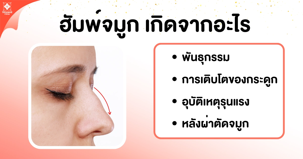 ฮัมพ์จมูกเกิดจากอะไร