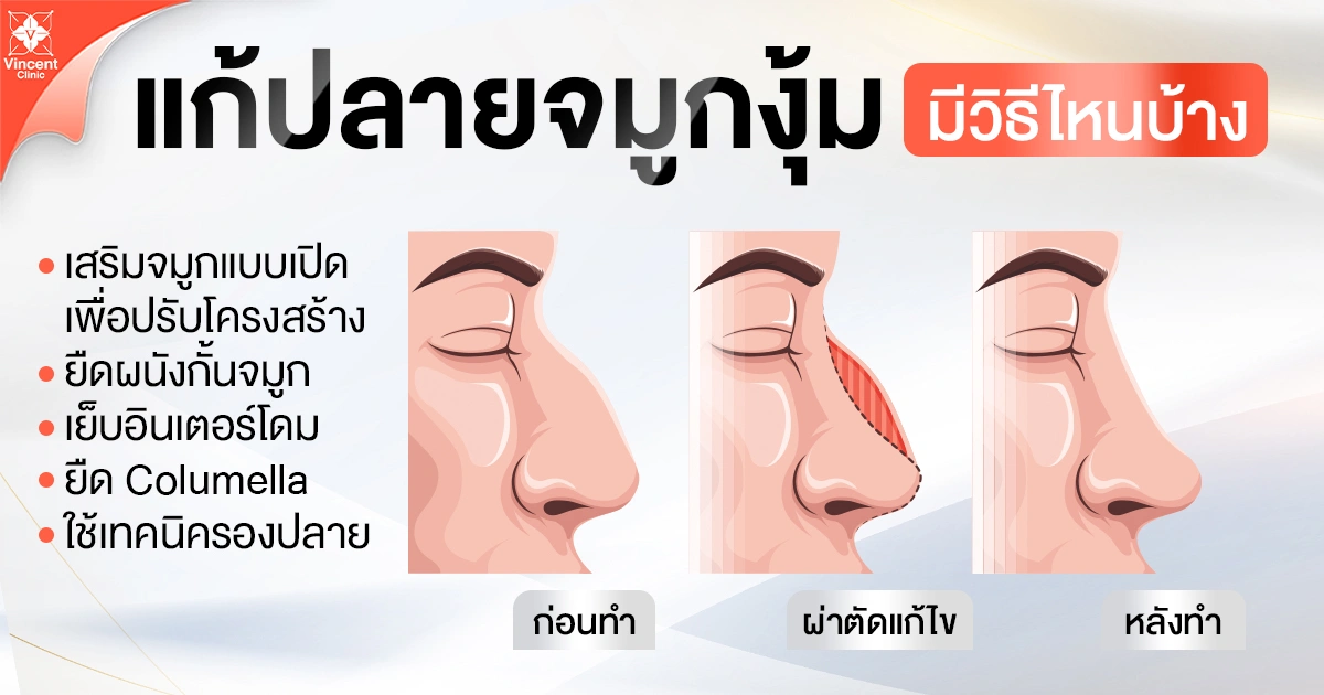 แก้ปลายจมูกงุ้มมีวิธีไหนบ้าง