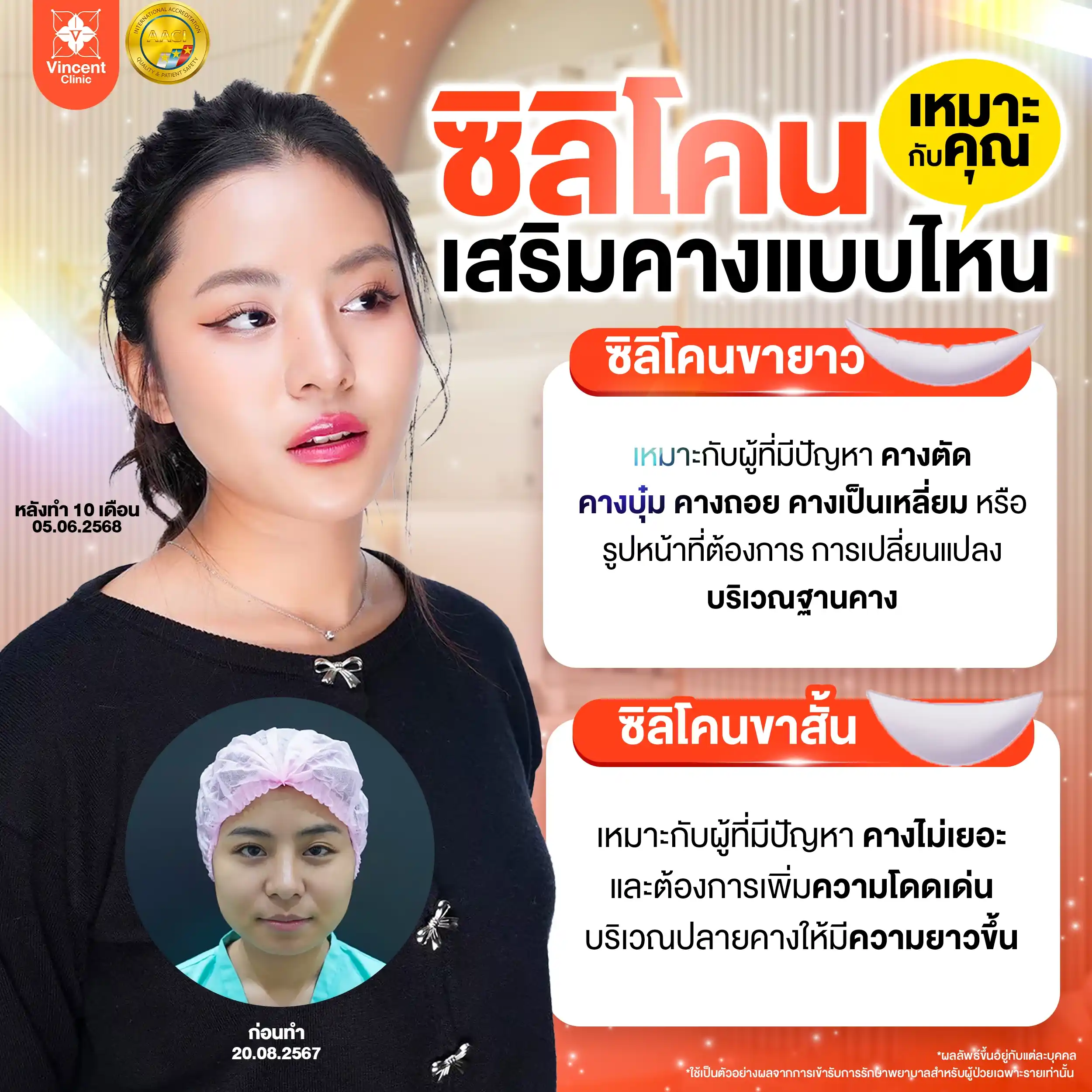 ซิลิโคนเสริมคางแบบไหนเหมาะกับคุณ