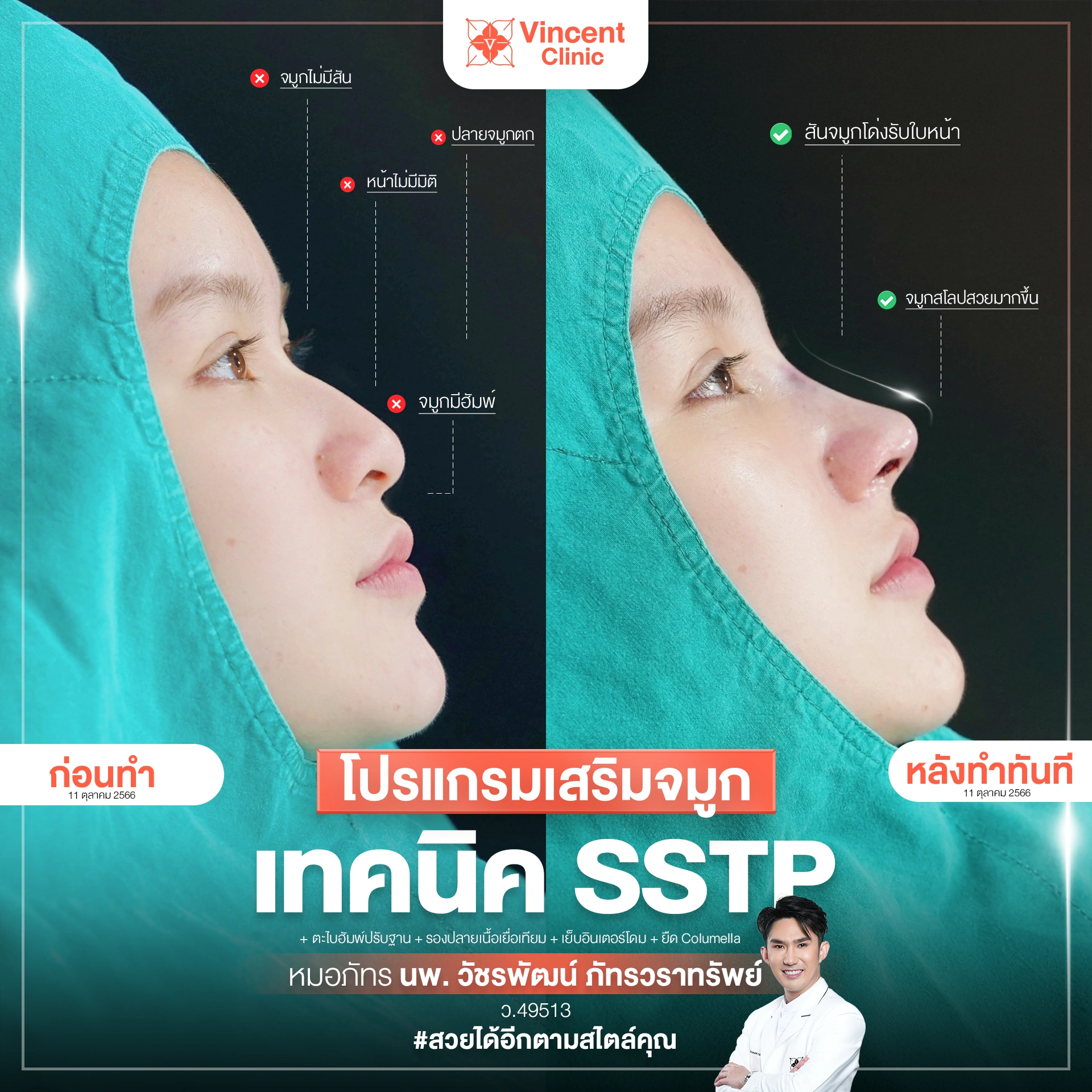 รีวิวเสริมจมูกพร้อมตะไบฮัมพ์ โดยหมอภัทร