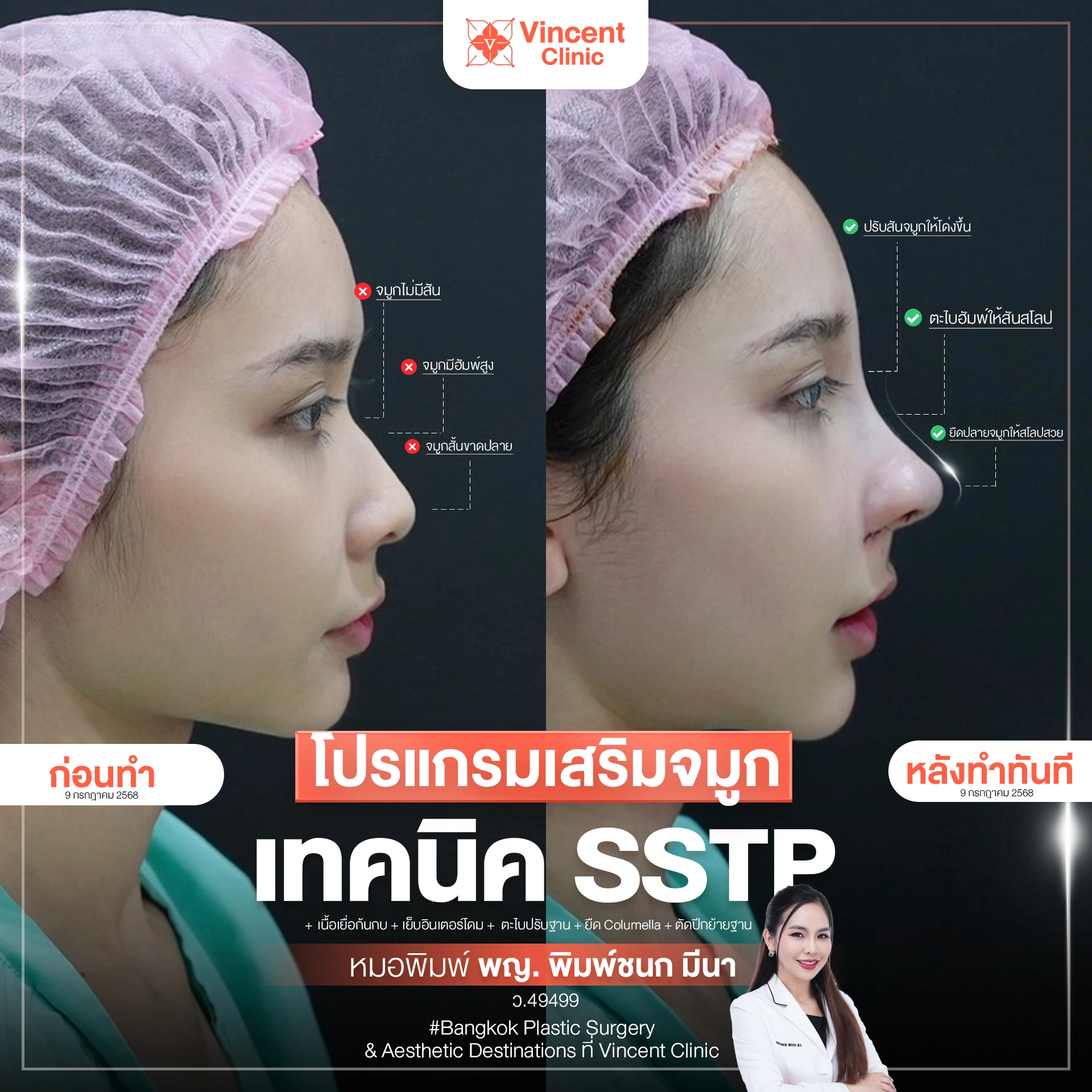 rhinoplasty hump reduction shaving by dr pim vincent clinic