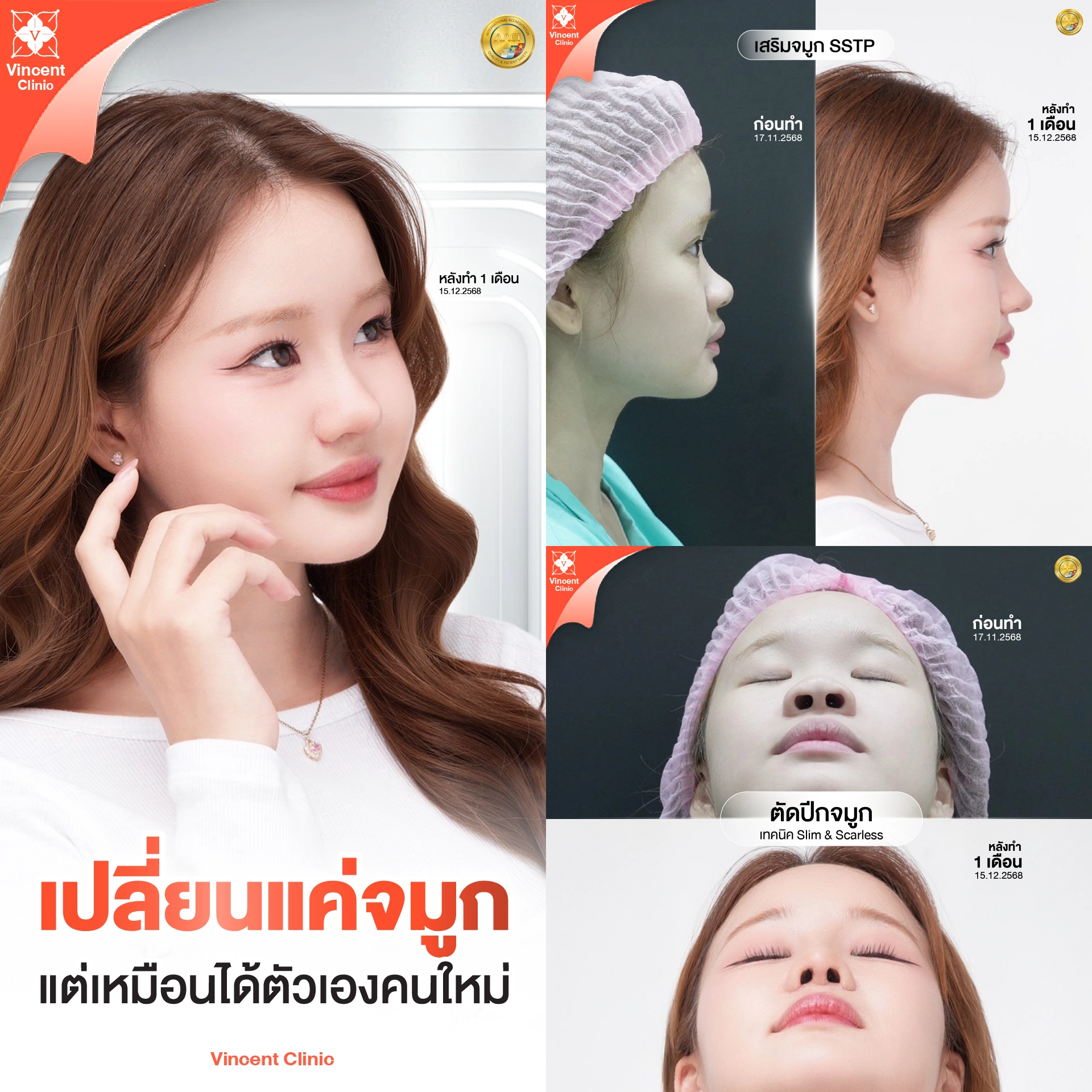 GP รีวิวเสริมจมูกตักปีก โอลิ 1 เดือน